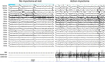 Deep-Phenotyping the Less Severe Spectrum of PIGT Deficiency and Linking the Gene to Myoclonic Atonic Seizures